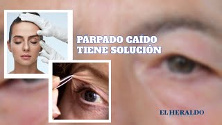 CódigoSalud  Párpado caído ¿Qué es en qué consiste la cirugía y cuánto cuesta [upl. by Teragram]