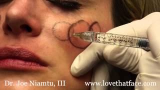 Juverderm Voluma 5 Minute Cheeks by Dr Joe Niamtu III [upl. by Icyaj]