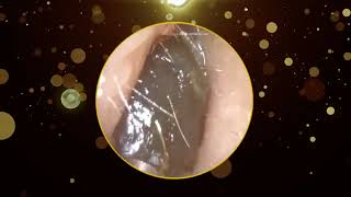 Hard Dark Stubborn Ear Wax Removal [upl. by Aron]