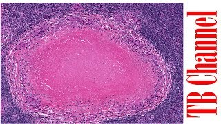 El granuloma de la tuberculosis [upl. by Jempty]