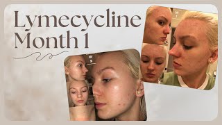 ACNE MONTH 1 ON LYMECYCLINE [upl. by Hamrah2]