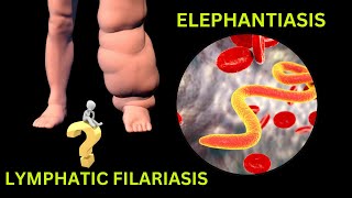 Lymphatic Filariasis Elephantiasis Causes Life Cycle and Treatment elephantiasis filariasis [upl. by Zacherie878]