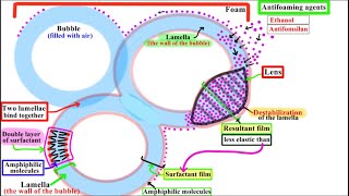 Pulmonary Edema Treatment using Antifoaming agents Ethanol and Antifomsilan [upl. by Eninnej]