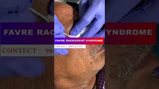 Things You Most Likely Didnt Know About Favre Racouchot Syndrome favreracouchotsyndrome shorts [upl. by Milburn680]