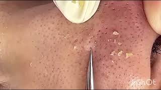 asmr blackhead removal Most satisfying video blackhead removal [upl. by Shah]