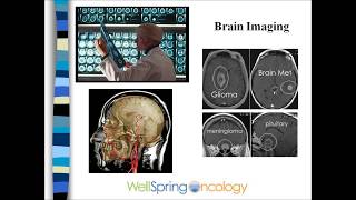 Brain Metastases [upl. by Naves]