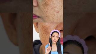 Best sunscreen for dark spots and pigmentation drsheths shorts indiansunscreen [upl. by Sacha]