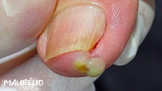 DEDO ENCRAVADO podologomaurelio podiatry satisfying [upl. by Martyn]