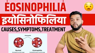 Eosinophilia Causes Symptoms amp Treatment In Hindi [upl. by Aletse]