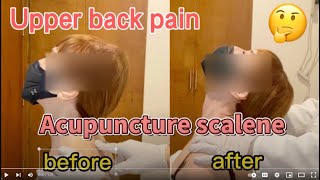 Motion Acupuncture for upper back pain Scalene injury Dr Decheng Chen [upl. by Ahsiekam]