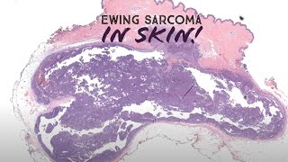 Ewing sarcoma arising in SKIN Australasian Dermpath 2022  Case 6 pathology dermatology [upl. by Ardnuat]