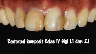 Restorasi Komposit kelas IV Gigi 11 dan 21 Komposit Asteria A3B dan Palfique LX5 A2 [upl. by Laspisa100]