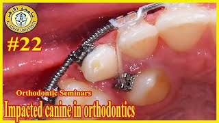 22 Impacted canine in orthodontics سيمينارات تقويم الأسنان جامعة الأزهر [upl. by Meaghan]