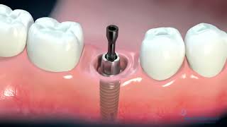 BEERISTA ILKAHA fayoclinic dentalimplants skincare beautydentaldigest [upl. by Aman]