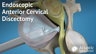 Endoscopic Anterior Cervical Discectomy [upl. by Giffie]