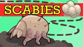 SCABIES Causes Signs and Symptoms Diagnosis and Treatment [upl. by Ajoop986]