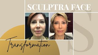 Sculptra Before amp After  My Review on the NonSurgical Facelift  Dominique Sachse [upl. by Ellehcal]