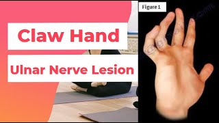 Claw Hand  Ulnar Nerve Lesion  PhysiotherapyKnowledge [upl. by Ahsinit111]