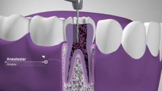 Endodoncia Dentimex [upl. by Hajidahk]