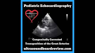 Transposition of the Great ArteriesDType [upl. by Ier]