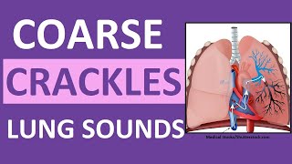 Crackles Coarse Lung Sounds  Crackles and Rales Breath Sounds Abnormal [upl. by Coffin211]