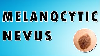 Melanocytic Nevus Symptoms Treatment and Causes [upl. by Arratahs]