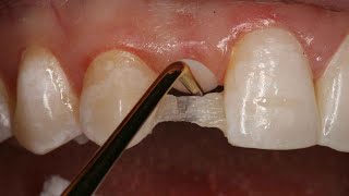 Direct Resin Bonded Bridge  Dental Online Training [upl. by Ennaharas]