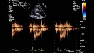 Normal Complete 2D Echocardiogram with Color Doppler and Spectral Doppler [upl. by Halli]