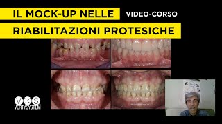 Come Eseguire i Mockup  Provvisori nelle Riabilitazioni Protesiche [upl. by Ackler]