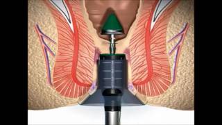 Stapled Haemorrhoidectomy using the PPH System  English [upl. by Erwin]