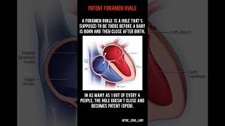 ASD or PFO 👇🏻🫀🤔 cardiology healthcare medical echocardiogram [upl. by Bore]