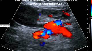 Thrombosed Superior Mesenteric Vein from Cancer of Pancreaswmv [upl. by Diamond]