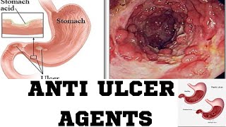 Anti Ulcer AgentsPPIH2 RECEPTOR ANTAGONISAMHARIC TUTORIAL [upl. by Ruscio645]