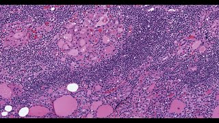 A Case Study on Oncocytic Carcinoma with Liver Metastasis Unusual Treatment Strategies [upl. by Varuag]