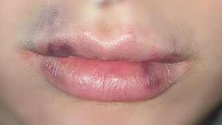 how to get rid of bruising after lip fillers tutorial [upl. by Muslim]