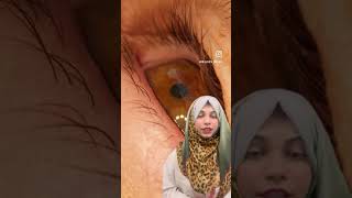 Subconjunctival hemorrhage 👁️👁️youtubeshorts shorts youtubevideos youtube youtube youtube [upl. by Philbo]