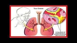 Les meilleurs remèdes naturels contre la toux grasse [upl. by Labanna448]