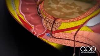 Prostate Cancer Labelled  3D Medical Animation  ABP © [upl. by Aeel]