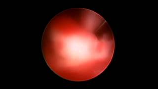 Hysteroscopy performed by Moreland OBGYN [upl. by Clemens]