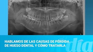 Hablamos de las causas de pérdida de hueso dental y cómo tratarla [upl. by Georgi]