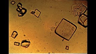 Urate crystals in Urine [upl. by Alyac]