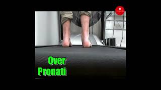 Discover the secrets of Over Pronation in our latest video Stay informed stay healthy [upl. by Nnalyrehs]