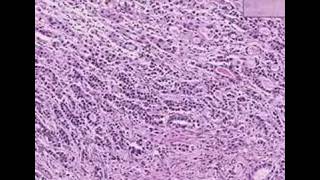 Histopathology StomachAdenocarcinoma [upl. by Nazay906]