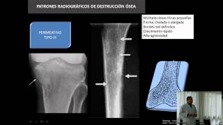 Aspectos Radiológicos de los Tumores Óseos [upl. by Zirtaeb]