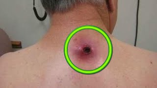 Cease and DeCyst 14 Minutes of Cyst Removal with Dr Gilmore [upl. by Ailhad110]