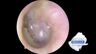 Perforated Purulent Otitis Media  Otite moyenne purulente perforée [upl. by Joannes]