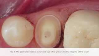 How to complete a post procedure using FibreKleer 4x Fiber Posts [upl. by Blaise]