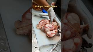 Multiple fibroid uterus specimen [upl. by Behlke]