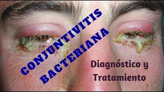 Ojo rojo por conjuntivitis bacteriana Tratamiento [upl. by Waligore617]