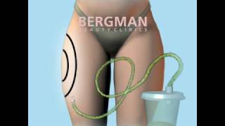 Liposuction animation Bergman Clinics [upl. by Melony69]